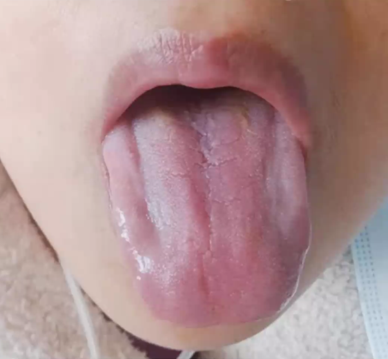 myokoi1962's tweet photo. 中医学の診断から、新型コロナウイルスの感染者の舌象は黄色のこのような状態が観察されているとの報告。左側は正常な人の舌象。PCR検査を受けられない日本の皆さん。舌を確認する方法は、目安になるかもしれません。　#中国 https://t.co/Po02VIAkG1