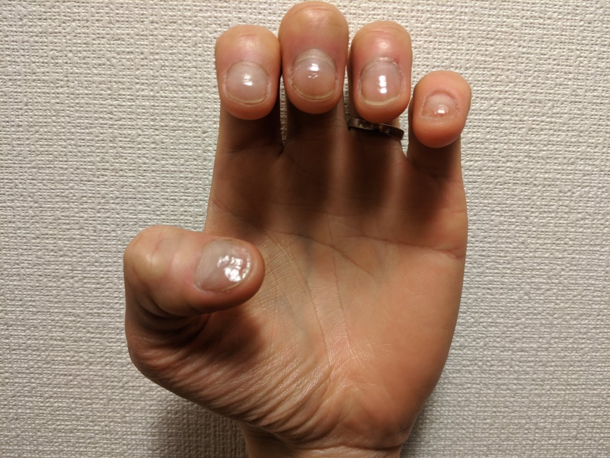 爪噛み男 Nail Biter V Twitter 55日目 無傷 みなさんの言うハイポが伸びない時期にようやくきた感あり 嬉しい Day 55 No Biting Need To Care Hyponychium To Grow 爪噛み克服 深爪矯正 Stopnailbiting T Co Knfvwnygkm