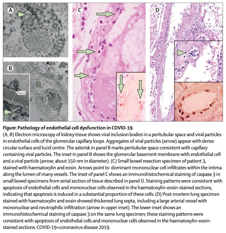 Severe  #COVID19 induces an endotheliitis: a pseudo-vasculitis phenotype with a viral renal-lung syndrome and ARDS. Nephrologists report AKI without shock/renal hypoperfusion. Microvascular endotheliitis also explains cardiac manifestations & thrombosis  https://www.thelancet.com/action/showPdf?pii=S0140-6736%2820%2930937-5