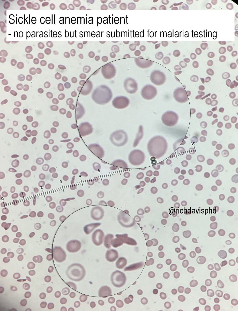 richdavisphd's tweet photo. Dr. Hermelin @HermelinMD  is a great social media laboratory advocate and educator.

Pic is from the micro lab, but no pathogens here. Malaria smear has no malaria, but shows distorted RBCs: this patient has diagnosed sickle cell anemia #LabWeek2020 #VirtualLabWeek #MLPW2020 https://t.co/Cx6PAolUwH