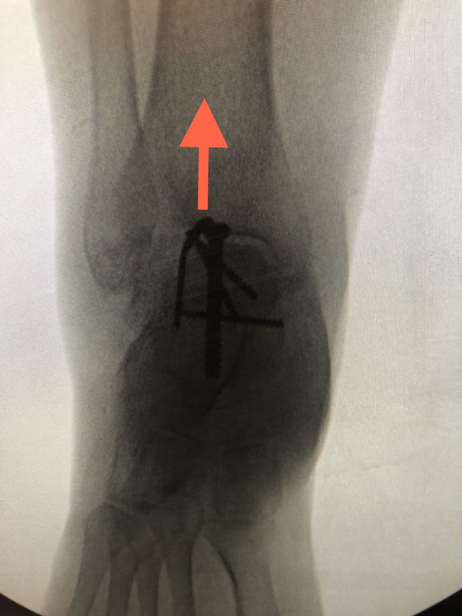 [4/6] Because I didn’t think 1 screw was enough, I used a lateral hook miniplate to counteract tension forces (red) and get more fixation in fragment. This was casted in slight plantarflexion. For another cool technique to protect skin, read for free here:  https://journals.sagepub.com/doi/pdf/10.1177/2473011417712185