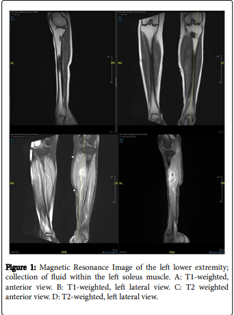 clininfectidis's tweet image. An Unusual Case of #Pyomyositis in a Neutropenic Patient with #Acute Myelogenous Leukemia.
For more details: bit.ly/2EQ7KNI