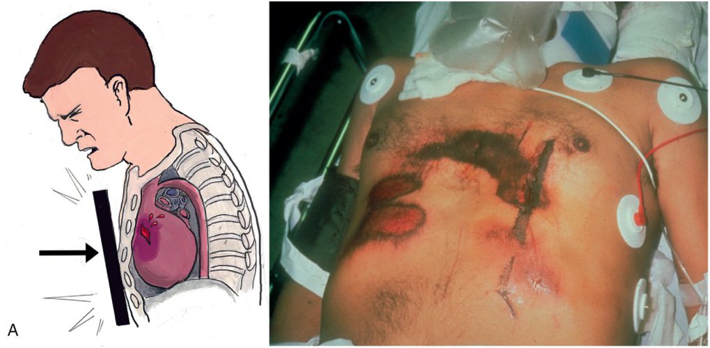 M Y W A Y I C U E R On Twitter chest Trauma Https t co UHvz9LGJeM