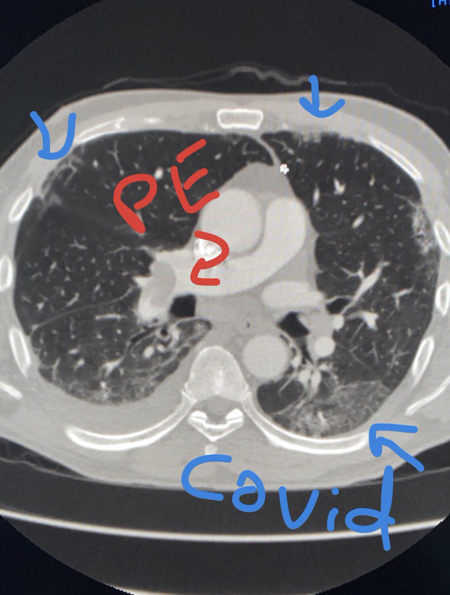 Covid patient extubated one week prior returns to ED with massive pulmonary embolism in right main pulmonary artery.  Watch out for that hypercoagulability!