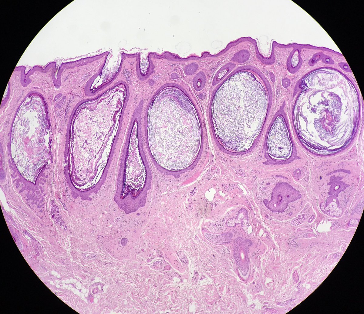 Beautiful example of comedonal cysts
#SkinPath #Pathology