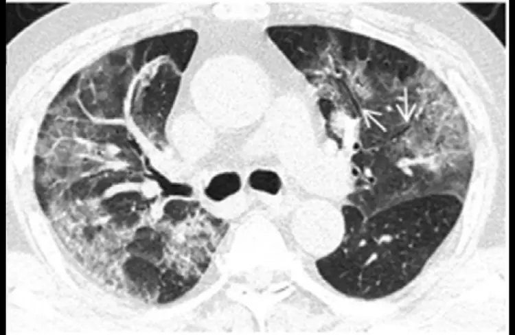 Here is a Covid CT lung. Do not ask me what the arrows are for, I don't do lungs. I only do the light coloured thing in between them. Anyway it looks pretty bad all over.(Interestingly the bronchi are wide open though)