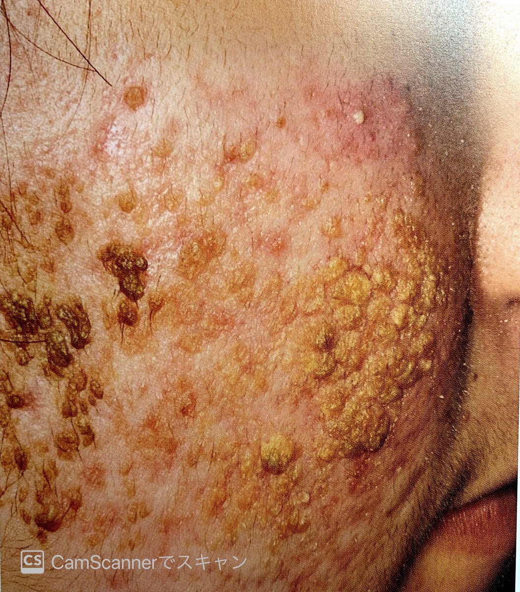 Uzivatel Mimi ベビーオイル洗顔の人 Na Twitteru あかつき病 普通の皮むけなどとはかなり異なる感じですか それとも素人目では見分けることができないような感じなのかな 初めて聞いた病気ですしネットには重症度の高そうな方の写真ばかりで謎が深まっています