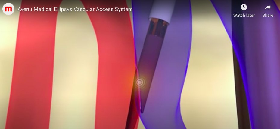 ssfarouk's tweet photo. Percutaneous #AVF are up against surgically created ones in #NephMadness #HDAccessRegion
One (of several) percutaneous technique is the Ellipsys system: https://t.co/eJhU0wSWsj
https://t.co/69ch29lPWK https://t.co/ASgIZ0lEDN