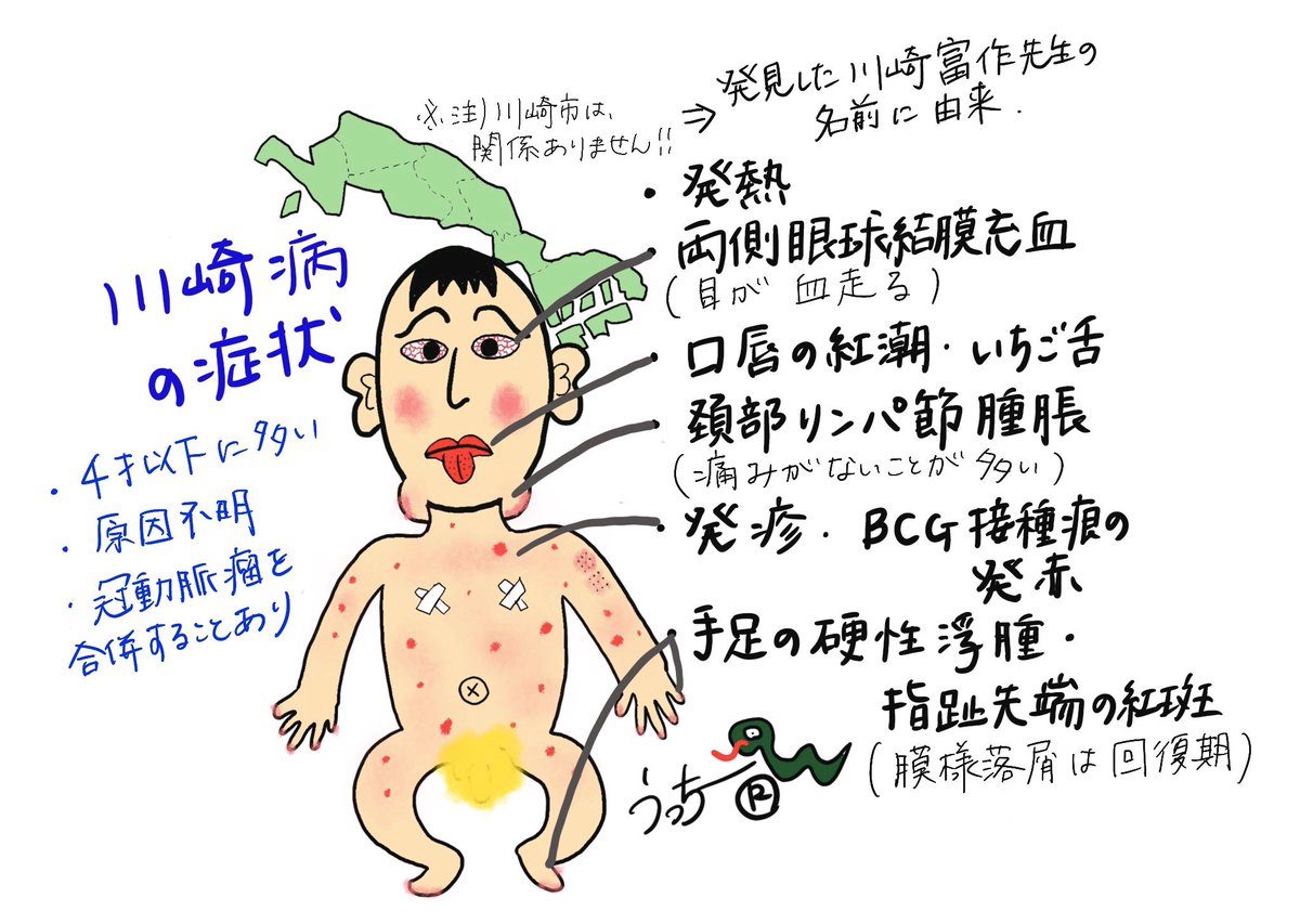 進化した川崎病の症状のイラスト。

川崎病は、地名ではなく発見された先生の名前に由来してます? 