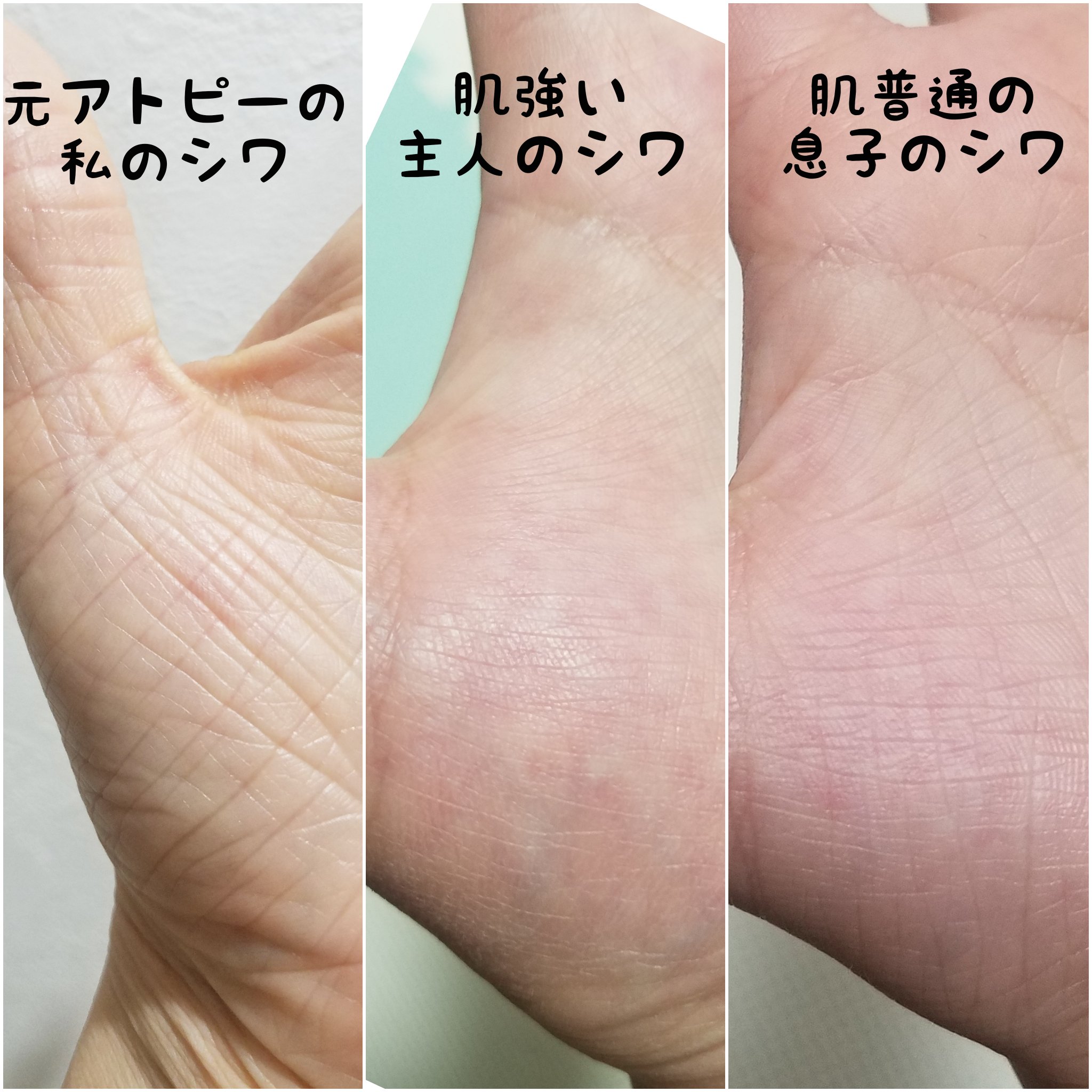 りと 乳頭縮小予定 元アトピー 手のシワのセラミドが作れない表の我が家のサンプルです 左の私の手 セラミド作れないシワレベル 残り2つ セラミド作れるシワレベル だと思います ご参考までに T Co 14iycd9ipz Twitter