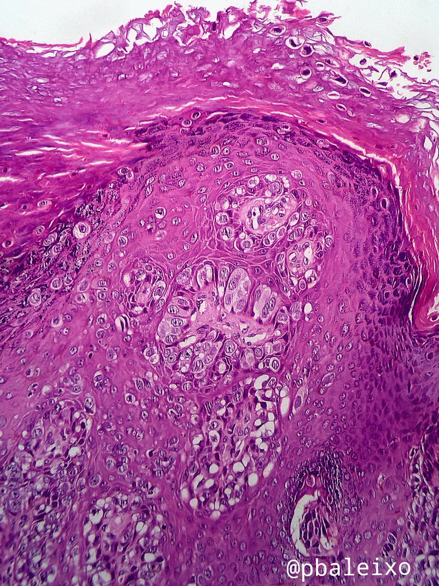 pbaleixo's tweet photo. 1/2 Extramammary Paget's disease of the scrotum #pathology #dermpath #microscopy @UFCSPA_patho @IHC_guy @smlungpathguy @JMGardnerMD @ariella8 @Patholwalker https://t.co/jxre12c1iY