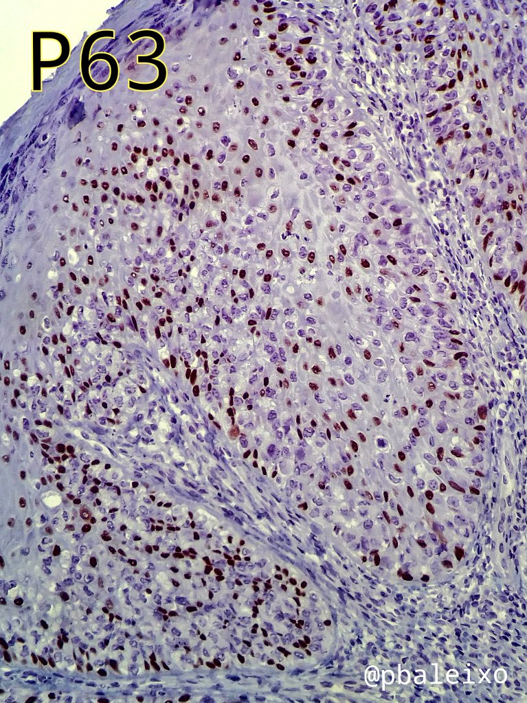 pbaleixo's tweet photo. 1/2 Extramammary Paget's disease of the scrotum #pathology #dermpath #microscopy @UFCSPA_patho @IHC_guy @smlungpathguy @JMGardnerMD @ariella8 @Patholwalker https://t.co/jxre12c1iY