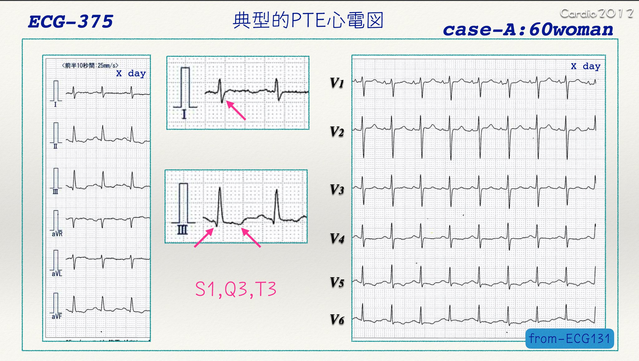 N Tsukishima 心電図検定試験対策 始めました A Twitter 心電図検定試験 Pte 02 これは 典型的心電図です S1q3t3 肺塞栓 Pe の心電図です この部分に 意識を集中しましょう 但し これが全て揃う肺塞栓は 10 くらいしか無いとされています