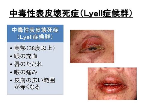 吾妻勇吹 趣味は理学療法士 A Twitter 中毒性表皮壊死症 Leyell症候群 これも副作用 自覚症状としては全身の10 以上に火傷のような水膨れ 皮膚の剥がれ ただれを認める 年間0 4 1 2人 100万人あたり こちらも原因となる薬を辞めると改善すると