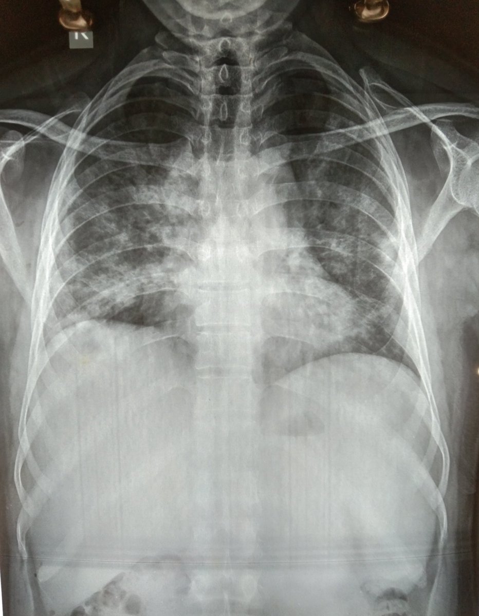 A running list of Chest x-rays of COVID 19 patients in my hospital, Mumbai, India @MayuriTrivedi80  @DigambarPanchal  @kidney_boy  @TedWJamesMD  @LangoteAmit  @arvindcanchi 1. 55 yrs, Male, Diabetic, came to EMS with Breathlessness SpO2 76%