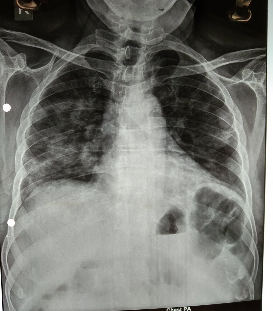 2. 66 yrs, Male, Diabetic, fever, non productive cough, breathlessness