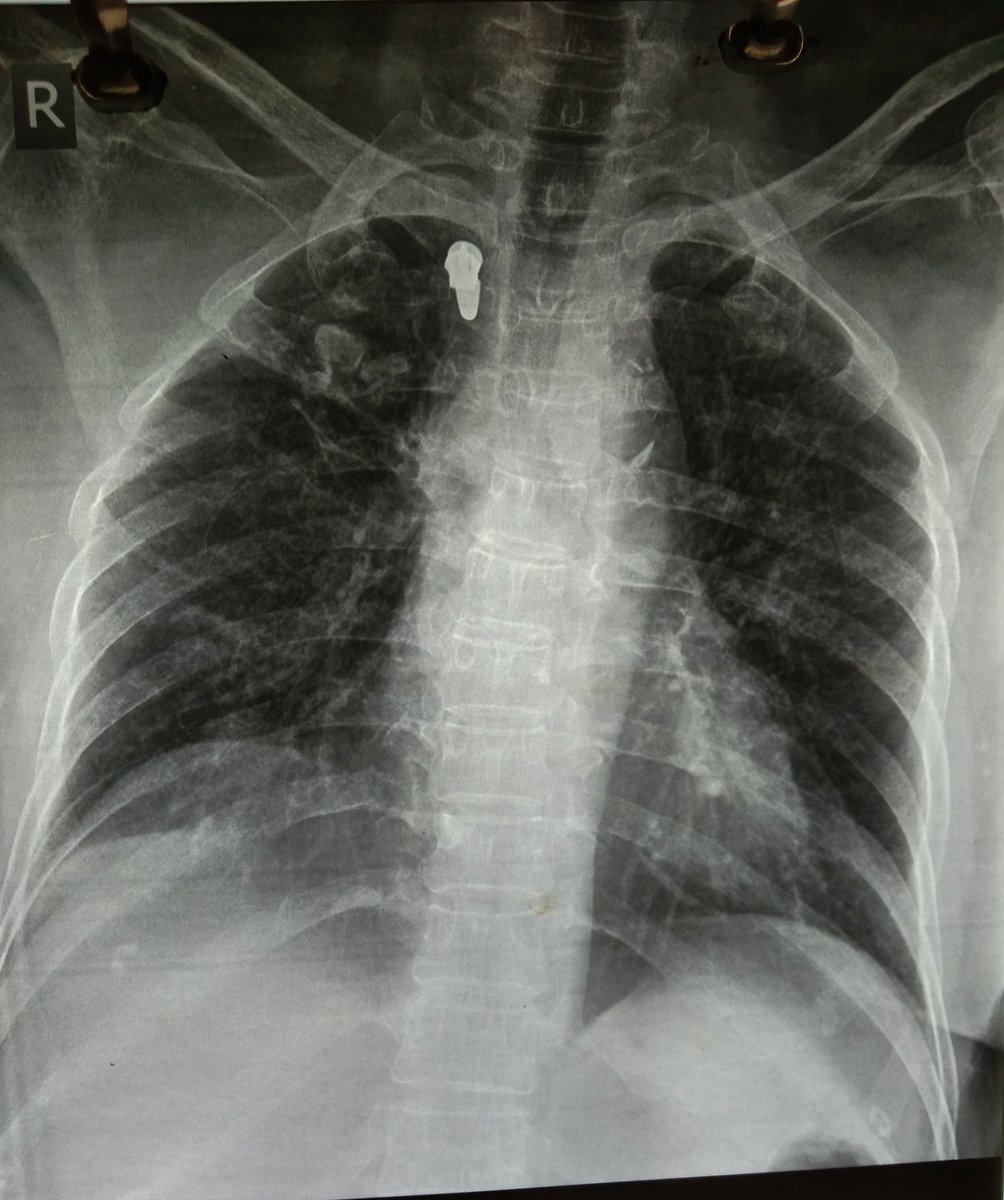 3.70/F, no comorbidities, presented with breathlessness and altered sensoriumSpO2 88% on Bag and Mask ventilation