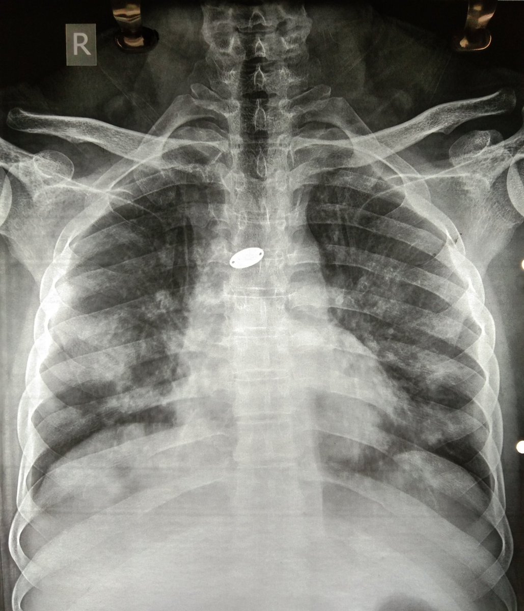 5. 54yrs, Male, Diabetic,HypertensiveCough with expectoration, fever since 4 days