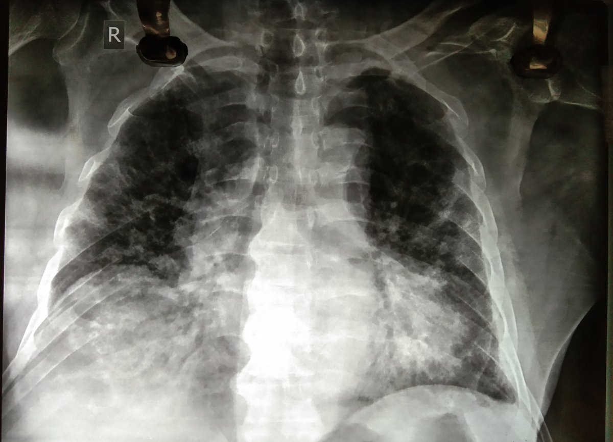 60/M, Diabetic, presented with fever , cough,breathlessness