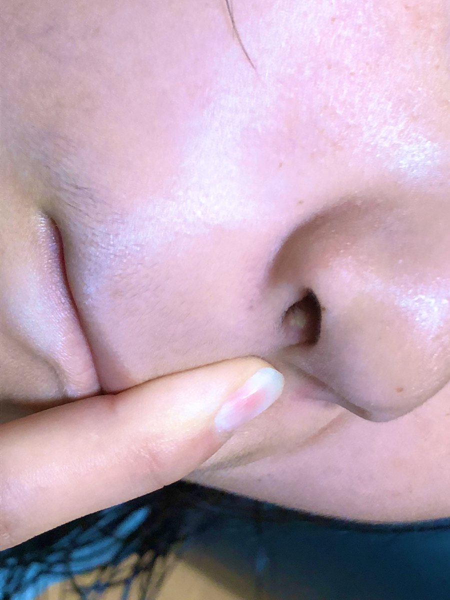 中 痛い の 鼻