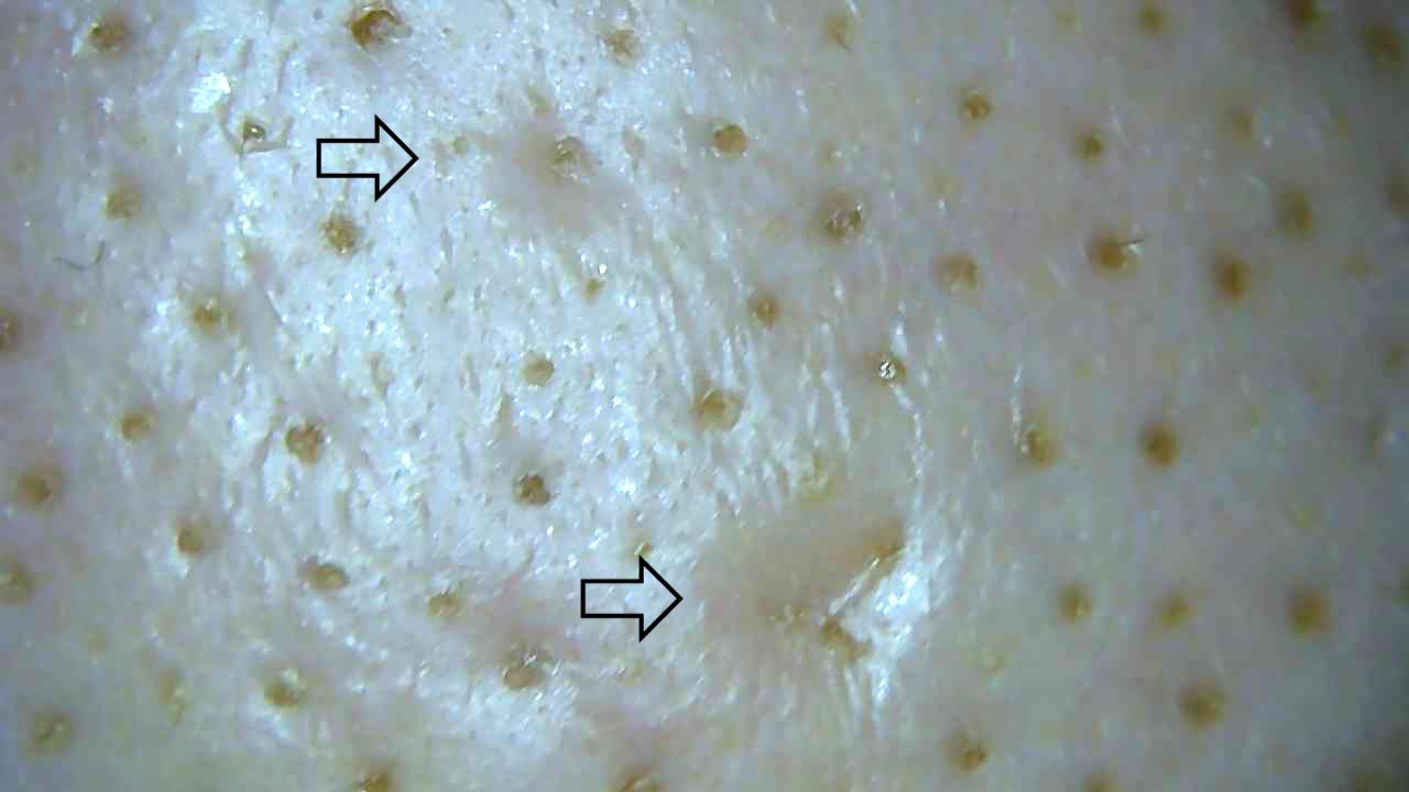 ぽこ Twitter પર 1年前アグネス受けたあと巨大な角栓ができて それを指で押し出したところが大きな陥没毛穴になってしまって 最近また気になるようになってきました マイクロスコープでみたらこんなになっててかなりショック 陥没毛穴にいい方法をご存知の方