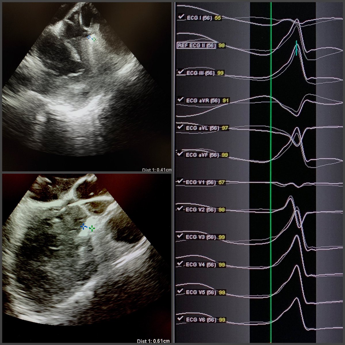 saumilshahmd's tweet photo. LVOT pvc. #viewmate to asses lesion depth. 0.41 cm (NS) cs 0.6cm (1/2 NS). @gargaatish87 @ZilinskasAshley https://t.co/jQ5cx4J9dK
