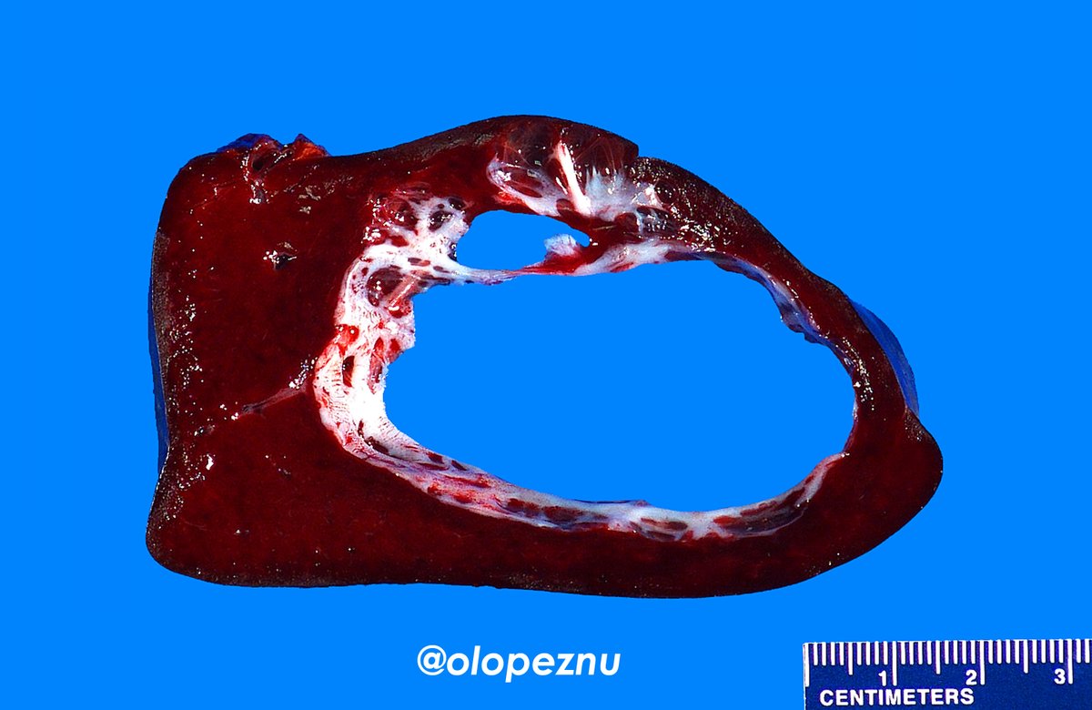 olopeznu's tweet photo. Incidental primary epithelial (epidermoid) cyst in an 8-year-old with splenic trauma. Its histogenesis is still unknown; however, embryonic inclusions have been proposed. #PediPath #Grossognosis #Pathology https://t.co/SUncepBMnF