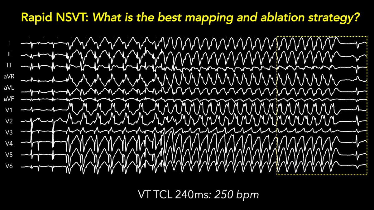 DrRoderickTung's tweet photo. 99 out of 100 #EPeeps are likely to acknowledge/insist that NSVT at a rate of 250 bpm is UNmappable.  Please reconsider with strategic multielectrode positioning (STaMP mapping) overlying a sinus rhythm #decelzone. #ablateVT #QSQ https://t.co/841z39SEid