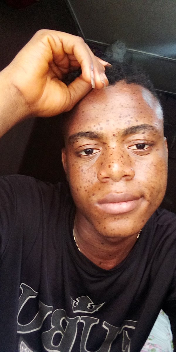HASSKYLOVE1's tweet photo. Freckled face β€οΈβ€οΈβ€οΈ
#LoveLikeRoksie #follobackforfolloback #follotrick #FolloForFolloBack #TooHotToHandle #OJORO #freckles #freckl #KimJongUn #Likee #RETWEEET #RETROGAMING #savagereplies #follo4follo #FolloMe #LoveLikeRoksie https://t.co/iHrt1Oe567