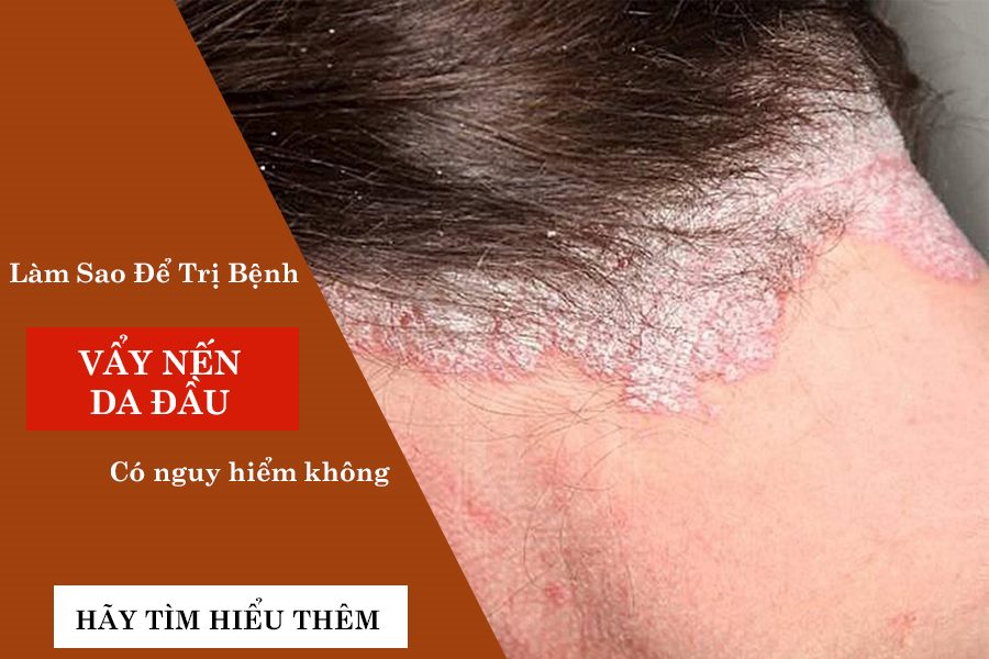 jakata1982's tweet photo. Các bác sĩ chuyên khoa da liễu khẳng định bệnh vảy nến da đầu hoàn toàn không có khả năng lây lan từ người này sang người khác khi tiếp xúc. https://t.co/0kIqlB2tLe https://t.co/WoSBffZjXh