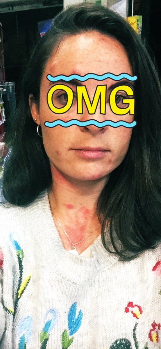 Pametruch's tweet photo. Si la vacuna del Covid-19 se tarda  tanto en ser descubierta como yo  cuando me picaron las chinches, agárrense... https://t.co/699M9lcbbh