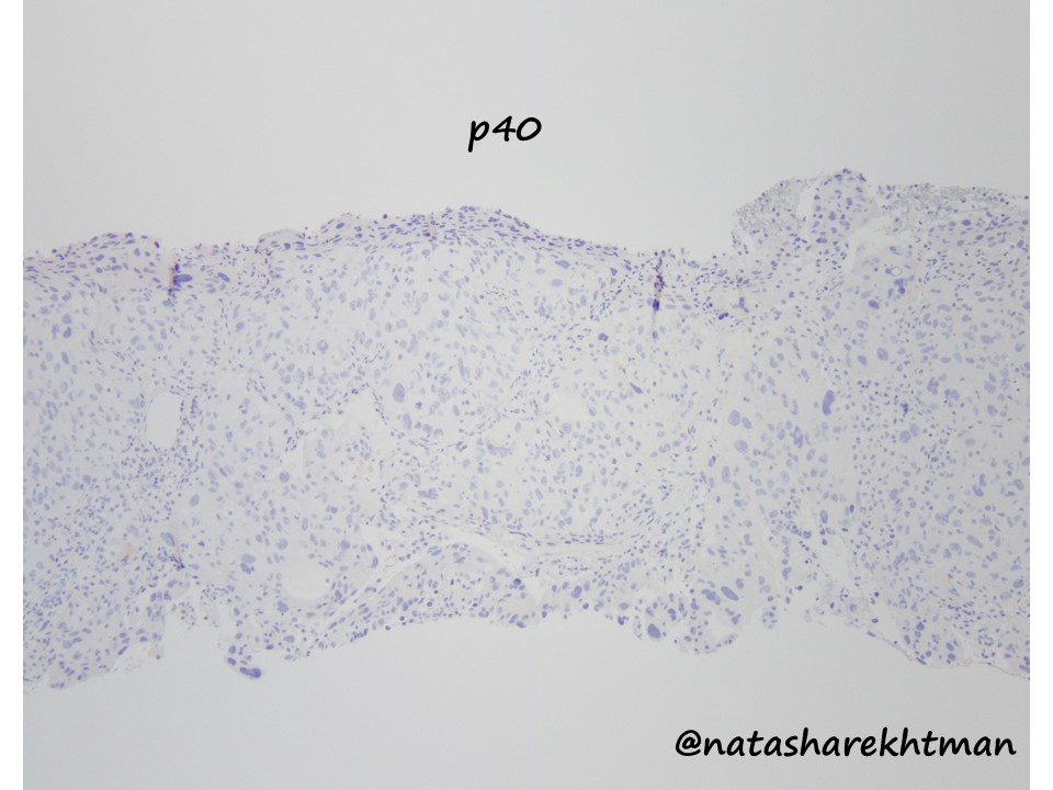 Thanks for all posts and lively discussion! If I saw this case just few years ago – for sure would have called squamous cell carcinoma without stains. Keratinization  Intercellular bridges  Or are they?? Here is IHC. This is a solid adenocarcinoma mimicking SqCC! More  1/