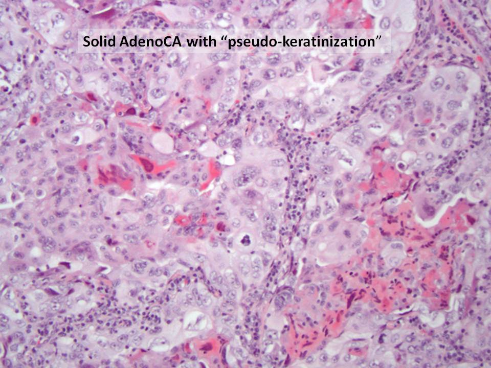 So how do we know there are NOT truly keratinizing cells? Indeed, p40 is negative in such cells (you should NOT use IHC for such cases!) But here is a great example of a similar case. Keratinizing cells should stain w/ high molecular weight keratins - these do not! 4/