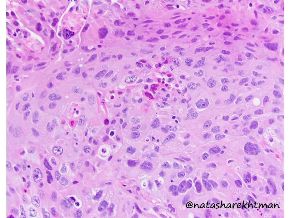 So what about our case? Cells do have sharp borders but NOT perfect IC bridges. Very important to know of this look of solid eosinophilic adeno in the lung – it is not uncommon! These tumors have molecular alterations of adeno (not SqCC) so important to be aware of these! 6/