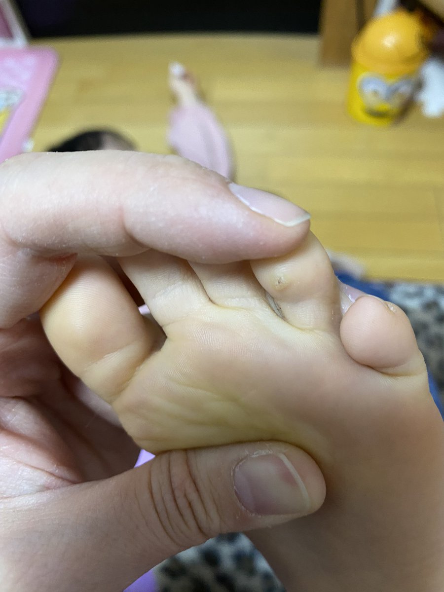 伊藤 ぴょ 多忙中 これタコ 昔の子供ってよく足の裏にタコ 魚の目 的なのできてなかったっけ W 昭和丸出しw それと同じ感じのやつなのかなぁ 明日皮膚科行って見てもらうかぁ ノd 子供 魚の目 足 伊藤 ぴょ 多忙中 これタコ 昔の子供ってよく足の裏にタコ 魚の目 的なのできてなかったっけ W 昭和丸出しw それと同じ感じのやつなのかなぁ 明日皮膚科行って見てもらうかぁ ノd 子供 魚の目 足