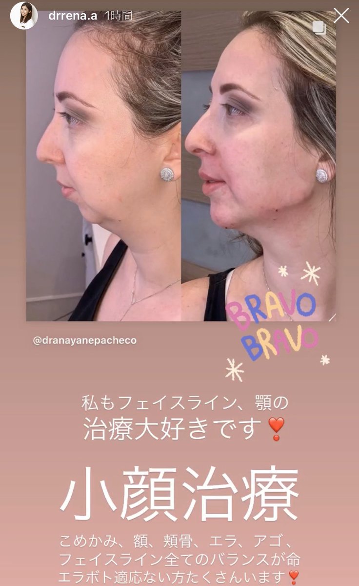 いちご鼻と戦うちゃん 輪郭はヒアルロン酸で作れるんだね 一枚目の女性は細面 面長感がすごく改善されていると思う