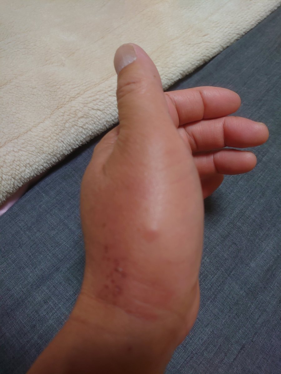 401子 手が腫れすぎてヤバい 赤ちゃんのﾌﾟｸﾌﾟｸ手みたいになっちゃった 明日医者行こう