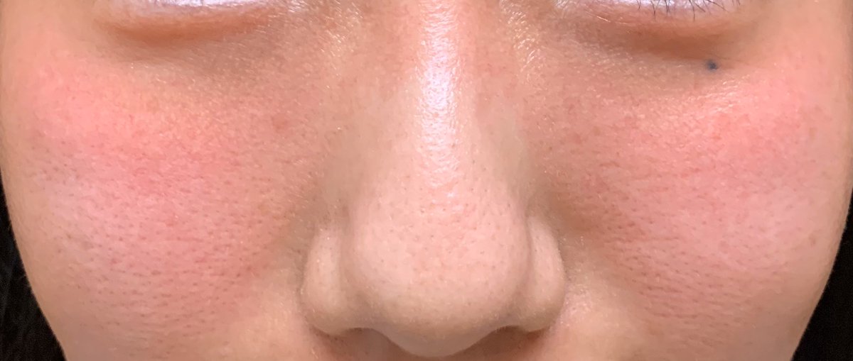 いちご鼻と戦うちゃん お酒を飲むと真っ赤になるタイプですが グリセリンフリーにした鼻の周りだけ綺麗に赤くなってない T Co Vsuobys2fe Twitter