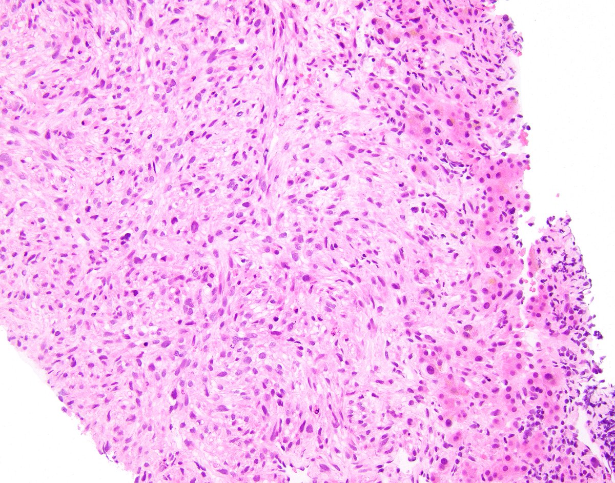science_press's tweet photo. Leiomyosarcoma involving liver (paranuclear vacuoles are indicated).  Our Survival Guide to Liver Pathology will be out soon! https://t.co/11aBMJG2Yg https://t.co/AI0O3yW7pn