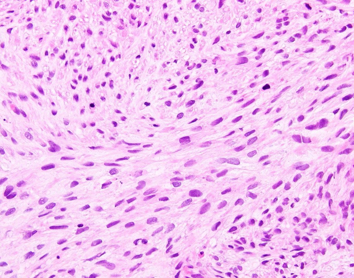 science_press's tweet photo. Leiomyosarcoma involving liver (paranuclear vacuoles are indicated).  Our Survival Guide to Liver Pathology will be out soon! https://t.co/11aBMJG2Yg https://t.co/AI0O3yW7pn
