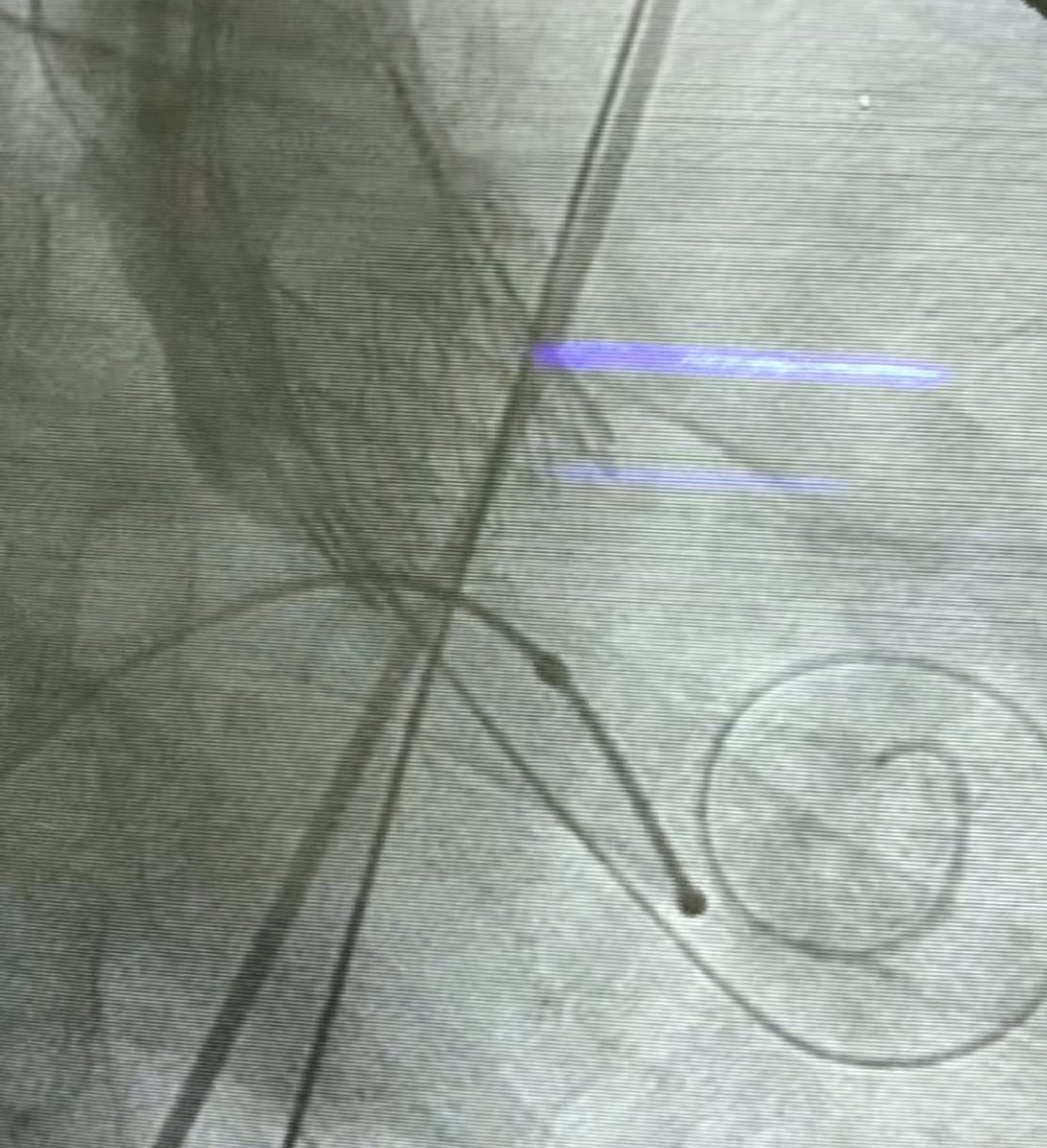 msztejfman's tweet photo. We did 3 TAVR this week during COVID 19 outbreak . At this moment our system is not collapsed ( 55% occupation in average) but  may be will be collapsed in 2 weeks. We preferred to implant high risk patients now instead to wait 2 o 3 months. ( 1st sincope, 2nd 35% EF, 3rd 125 PG) https://t.co/dxqHkCKTRK