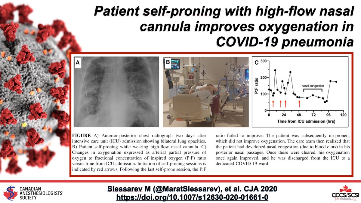 CJA_Journal's tweet photo. Patient #SelfProning with high-flow nasal cannula improves oxygenation in #COVID19 pneumonia from @MaratSlessarev 

https://t.co/6JFhOd5kz3 #Anesthesia #Anesthesiology #coronavirus #COVID19anesthesia #COVID19ICU @CASUpdate @CritCareSociety https://t.co/wiK8iB9nRG