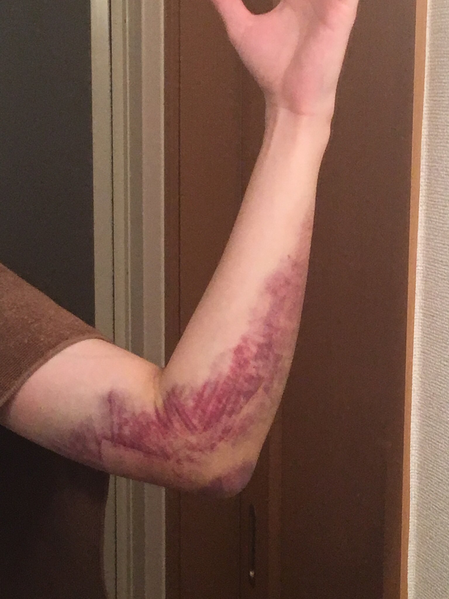 さとう 一年前ぐらいの写真だけど肘骨折すると2日後ぐらいに内出血でこれくらい紫になった 明日病院いくの T Co oqucaa00 Twitter