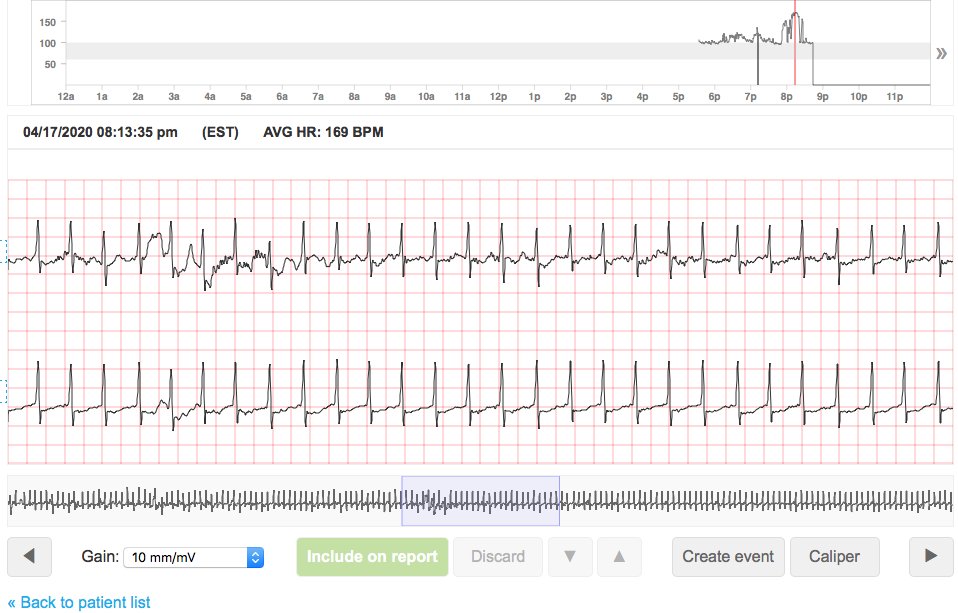 CMovsowitz's tweet photo. True mobile telemetry with heart rate trend provides opportunity for remote diagnosis and treatment in real time - valuable in preventing unnecessary ER visits in era of COVID19. https://t.co/uN4uQ6DcSw