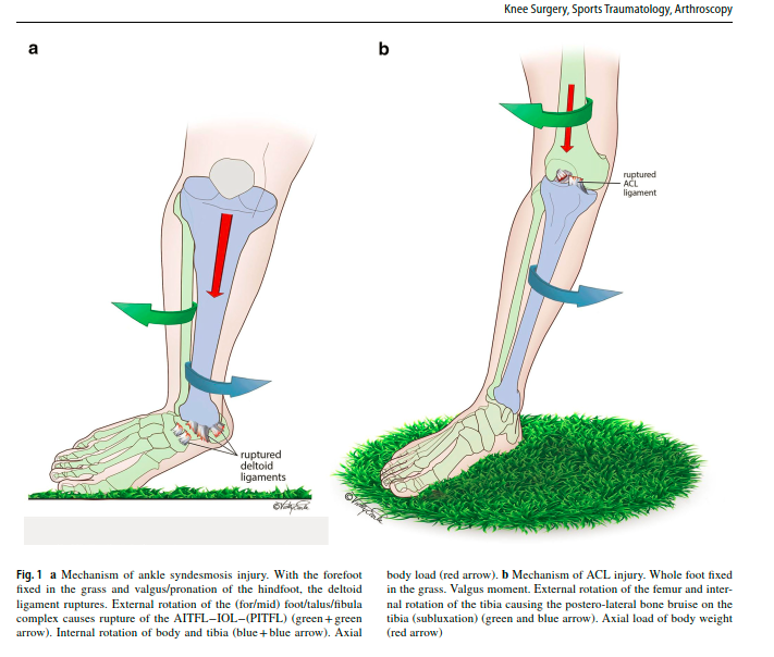 PhysioMeScience's tweet image. The ankle syndesmosis pivot shift “Are we reviving the ACL story?”

👀👀👇👇

link.springer.com/article/10.100…