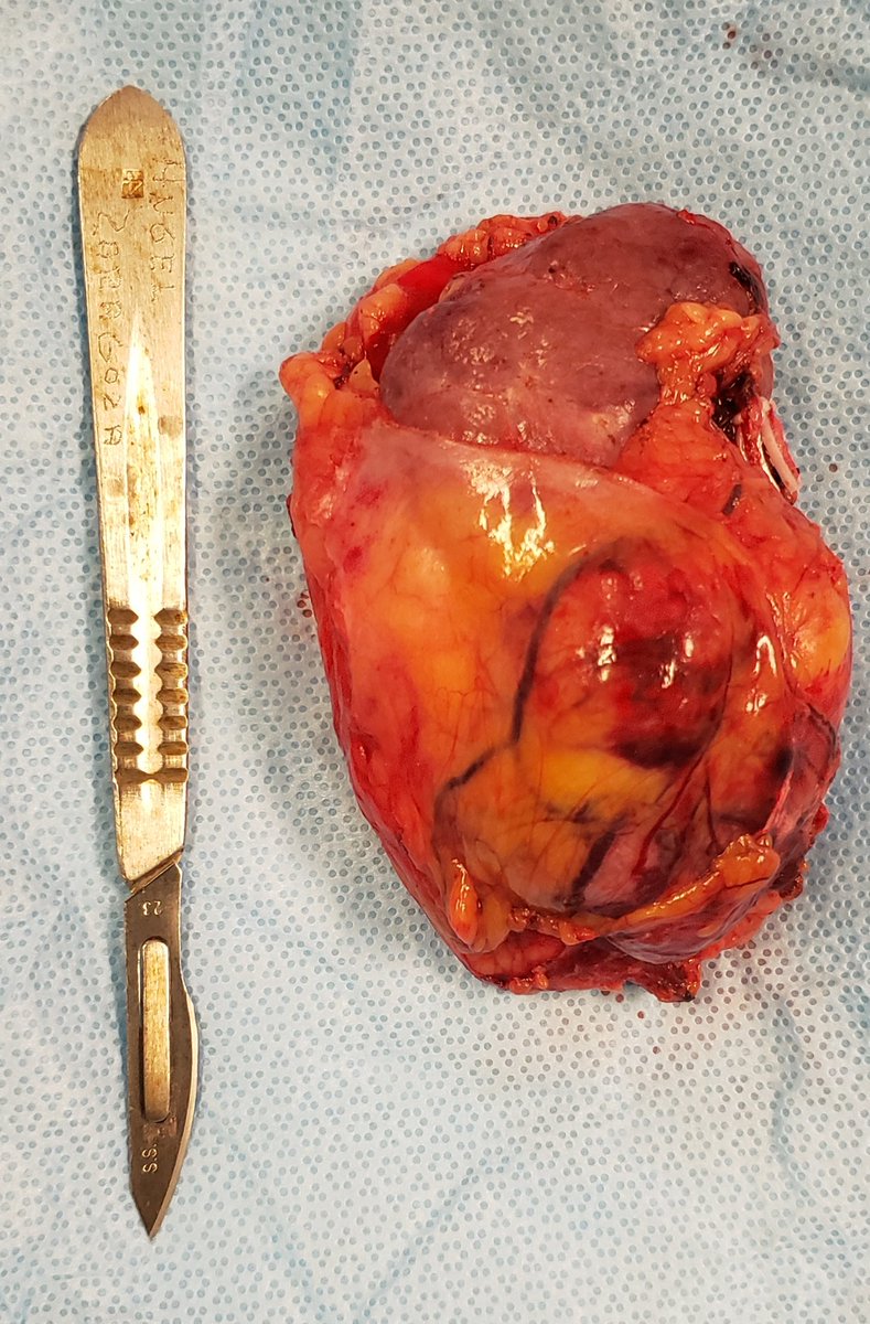 DrRodriguezUro's tweet photo. Nefrectomia Radical Laparoscopica por Tumor Renal Derecho T1b

Cirugia de minima invasion para un padecimiento que no da sintomas hasta que ya se convierte en una enfermedad avanzada.

#urology #urologo #monterrey #uroonco #oncology #renalcancer #laparoscopy #tumorrenal https://t.co/3ZE1JJj4qj