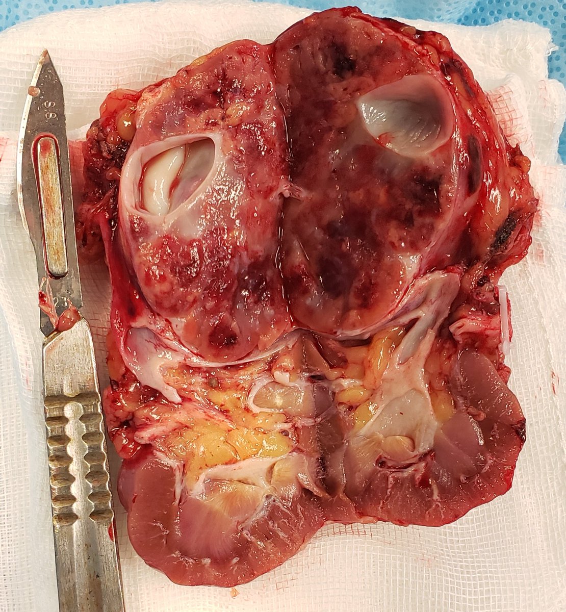 DrRodriguezUro's tweet photo. Nefrectomia Radical Laparoscopica por Tumor Renal Derecho T1b

Cirugia de minima invasion para un padecimiento que no da sintomas hasta que ya se convierte en una enfermedad avanzada.

#urology #urologo #monterrey #uroonco #oncology #renalcancer #laparoscopy #tumorrenal https://t.co/3ZE1JJj4qj