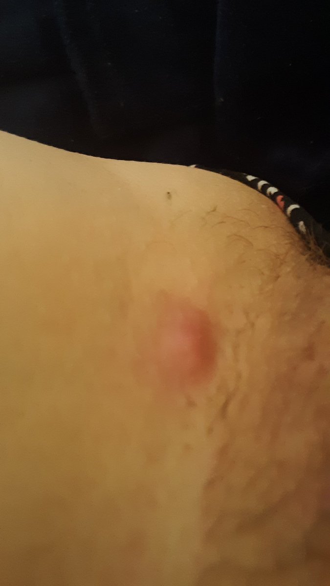 EquestrianBree's tweet photo. Latest DEW attack welt in groin. Ouch. It hurts bad. #electronicweapons https://t.co/E9QeSdLjs5