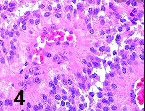 #OnePathBoardPointAtATime
📘4 types of Rosettes/Pseudorosettes to remember:

1⃣ Homer Wright Rosette:
First described in Neuroblastoma. 
Also in Medulloblastoma & other PNETs.
Tumor cells surrounding central area that contains neuropil (aka fibrillary or neuroblastic rosettes).