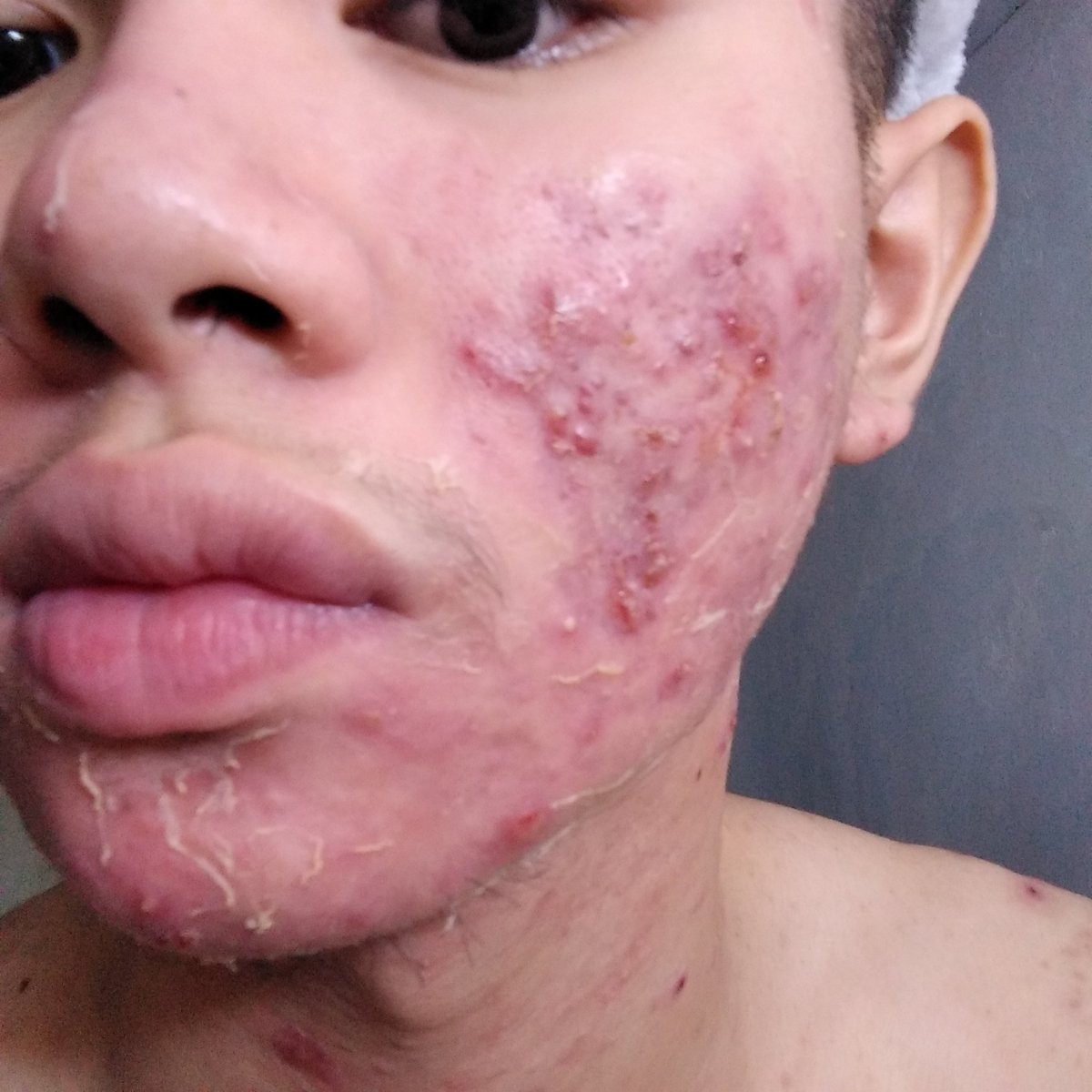 "Anong nangyari sa mukha mo?""Gwapo ka sana, kaso may pimples.""Yucks! Nag memake up ka? Kaya pala na irritate."Mga masasakit na salitang natanggap ko before. Hindi ko na alam anong gagawin ko. Natakot akong magpa derma, isa pa wala akong pera ipang gagasto. Sad.